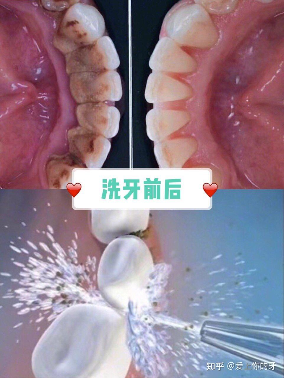 成都洗牙可以用医保吗(洗牙可以用医保吗,报销比例多少)